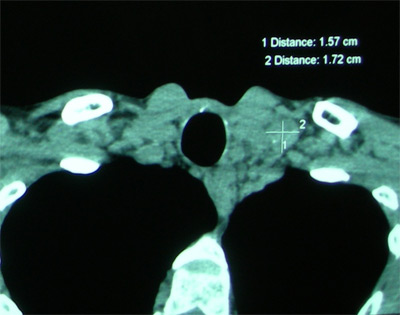 thyroid-gland-scan-tumour