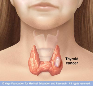 Thyroid Cancer Surgeon Sydney