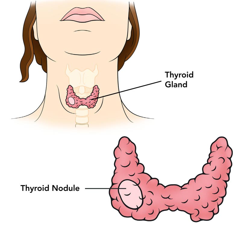 types-of-thyroid-cancer
