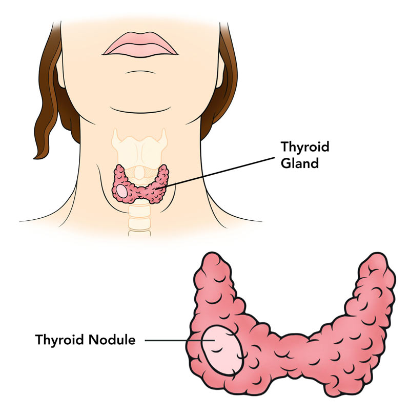 thyroid-disease-teflon