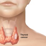 rising-incidence-thyroid-cancer