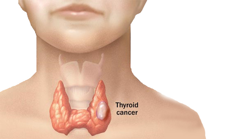 rising-incidence-thyroid-cancer