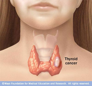 thyroid-cancer-overview